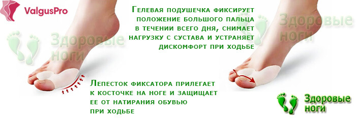 Принцип действия Вальгус Про - шины на большой палец